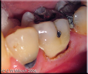 C6 tip gingivectomy 3 copy small.jpg